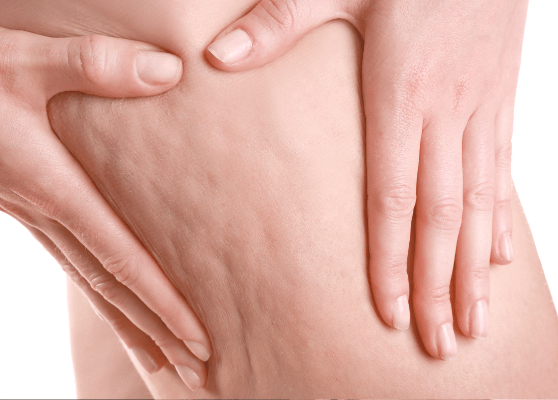 cellulite